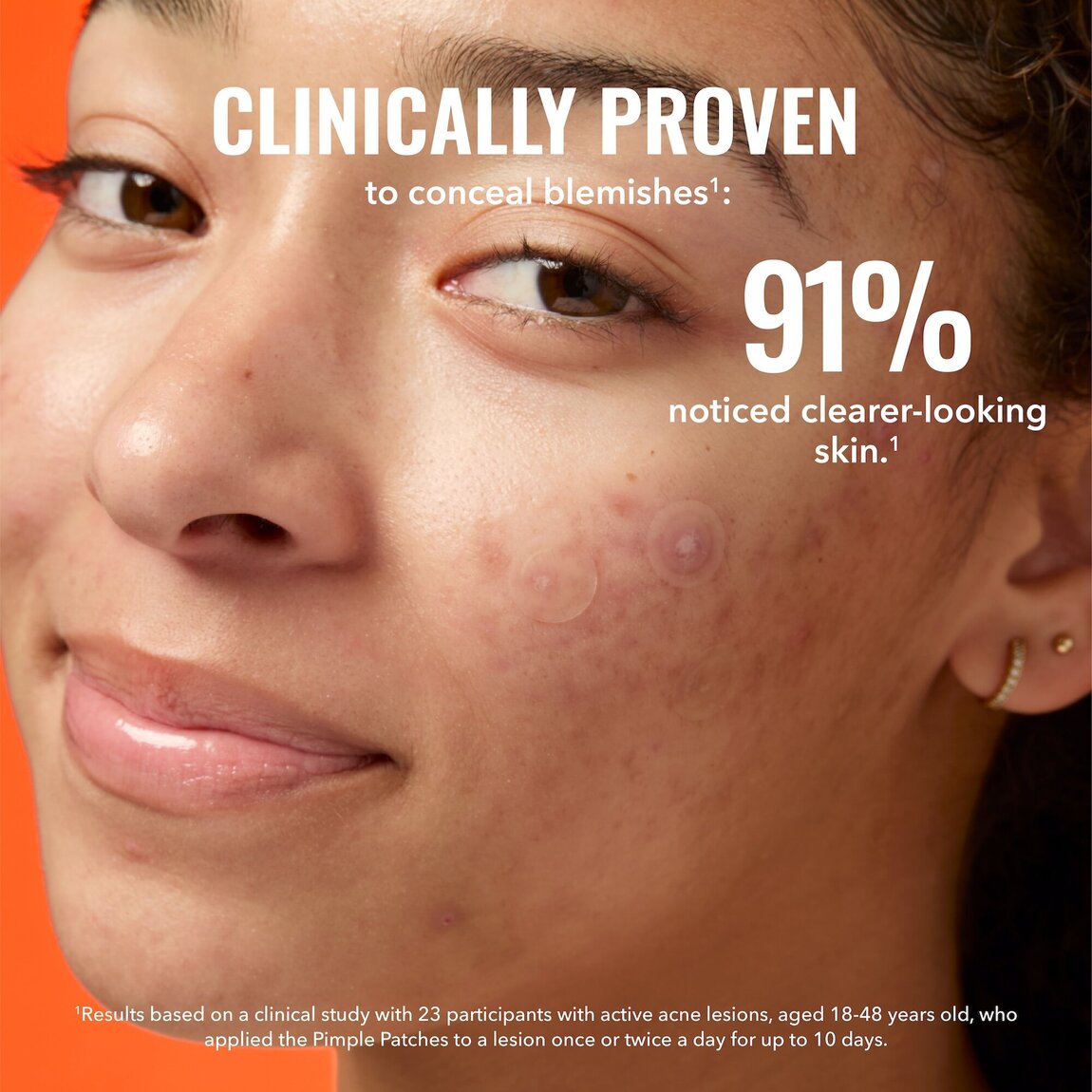 pimple-patches-u4 zb_p.jpg